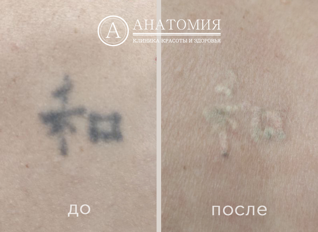 PicoSure | клиника красоты и здоровья_Москва